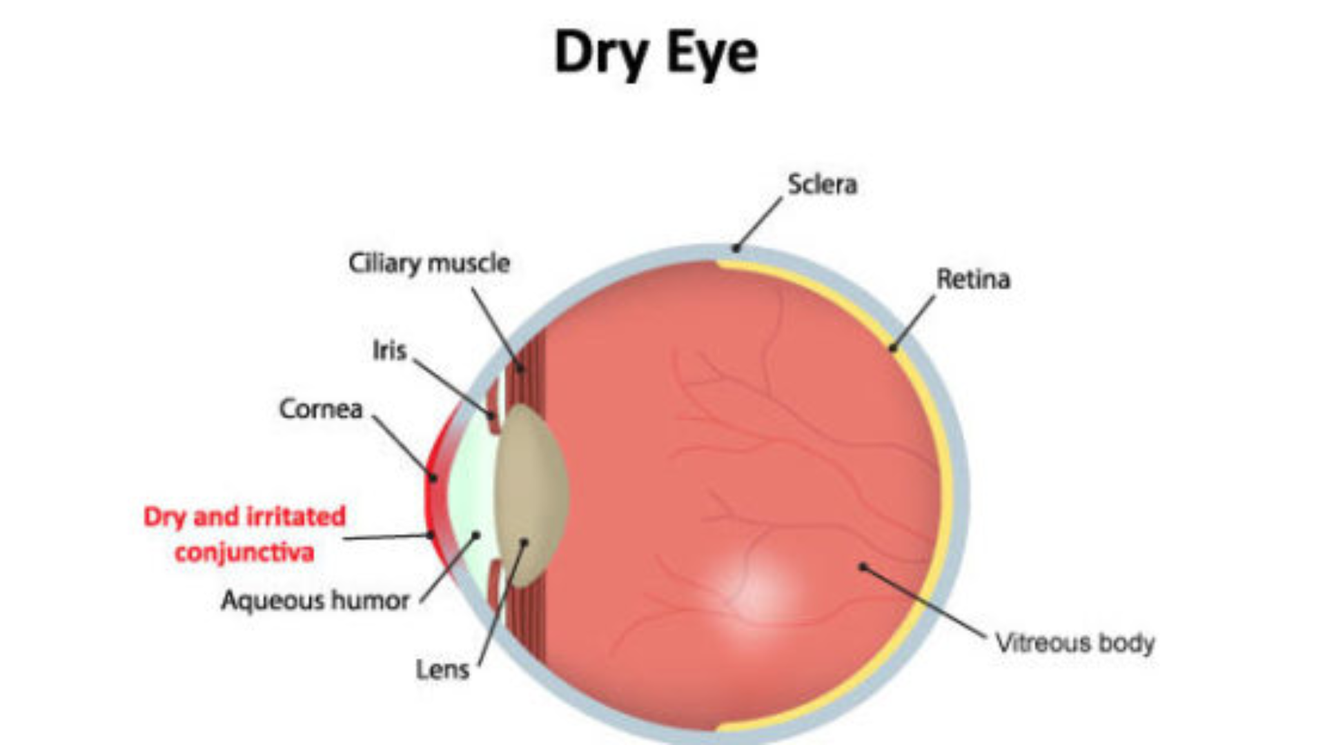 dry eye 1