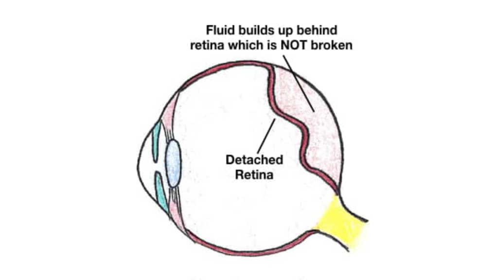 exud retina